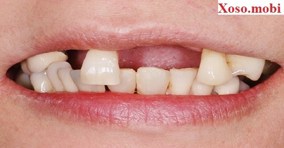 Mơ thấy rụng răng Mơ thấy rụng răng